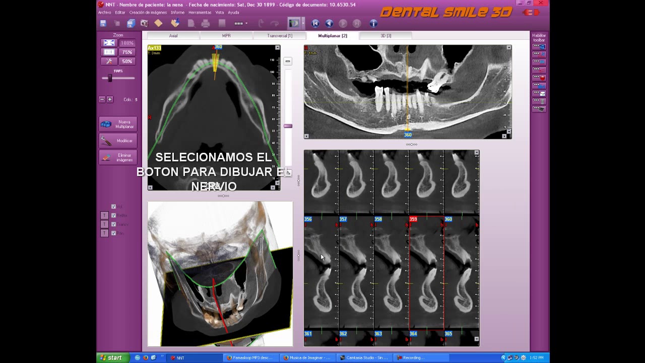 Irys Planificación para implantes dentales