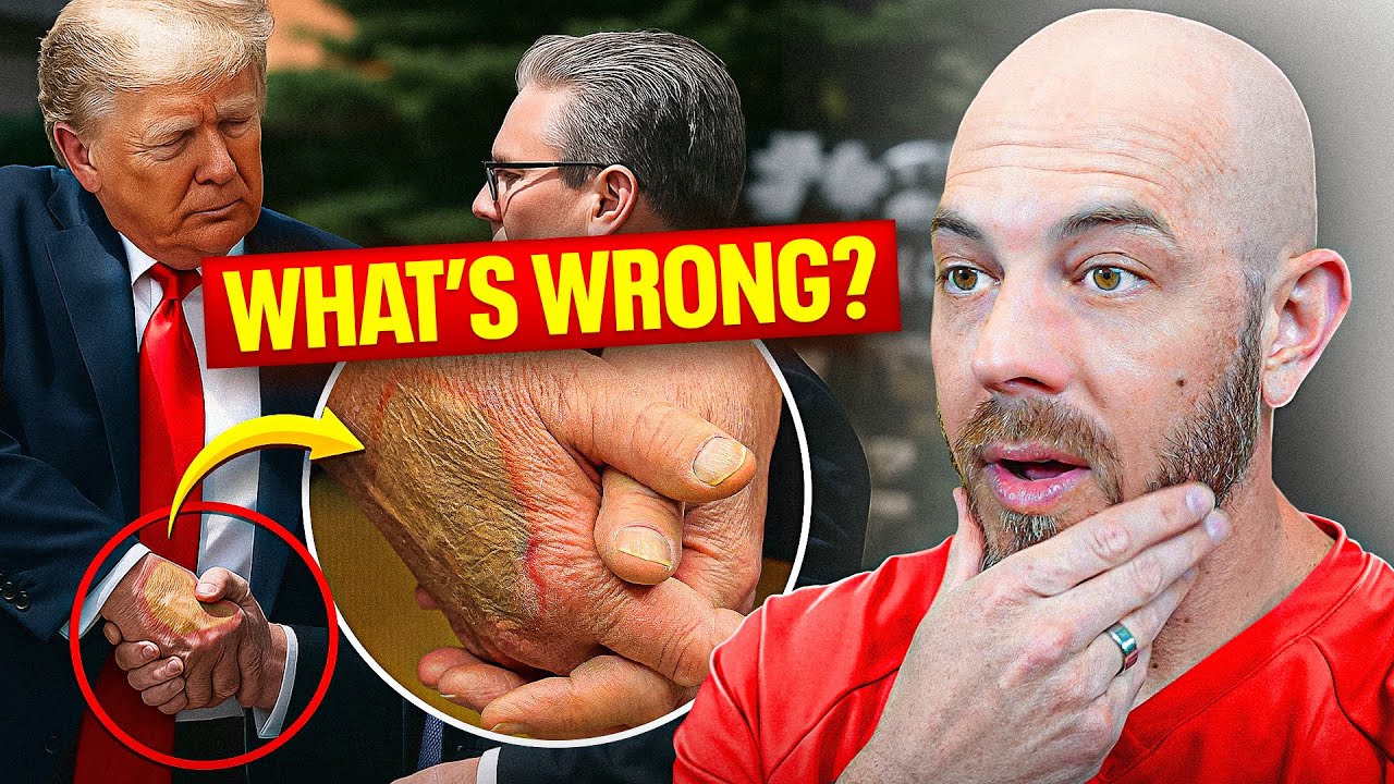 Dermatologist explains Trump&rsquo;s hand