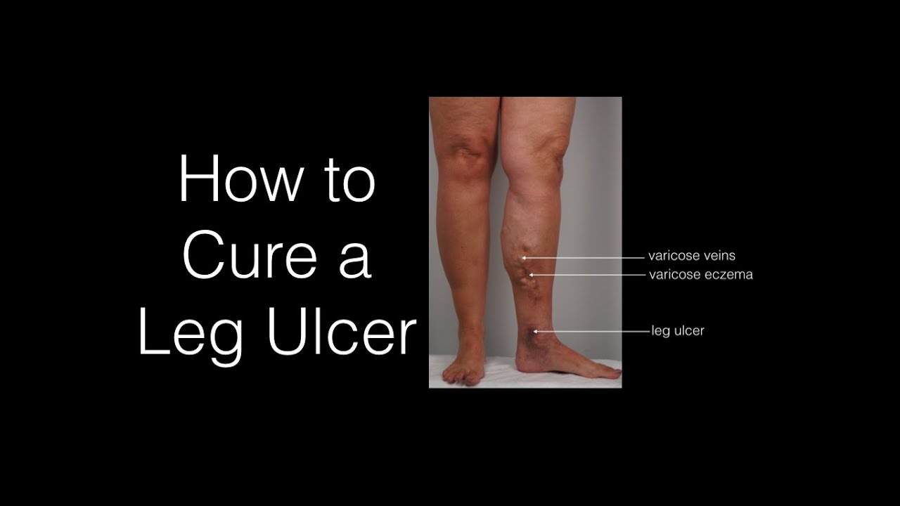 How To Cure A Leg Ulcer