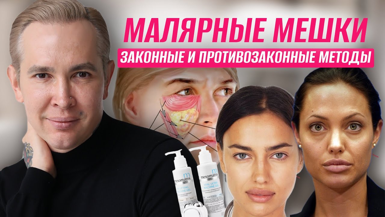 Малярные мешки ЗАКОННЫЕ И ПРОТИВОЗАКОННЫЕ методы удаления  Реальное избавление от мешков под глазами
