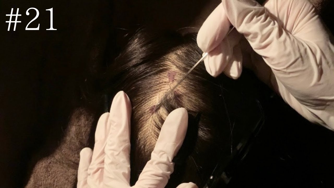 #21［ASMR］Scalp Check  / Medical / Lice Check / role play no talking / binaural