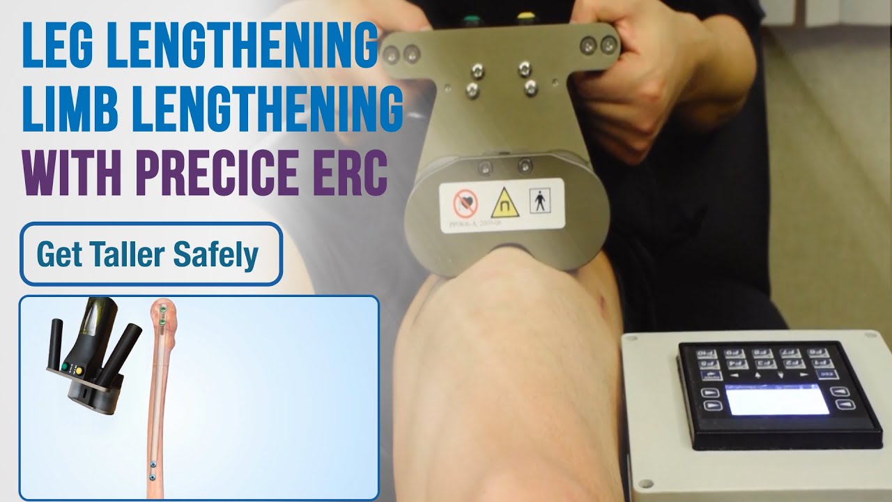 Leg Lengthening (Limb Lengthening) with Precice 2 ERC