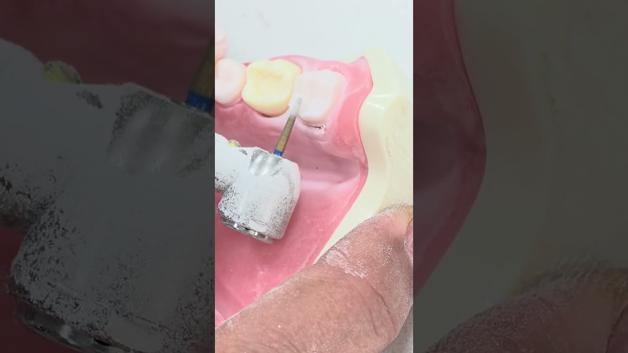 Crown preparation for lower molar
