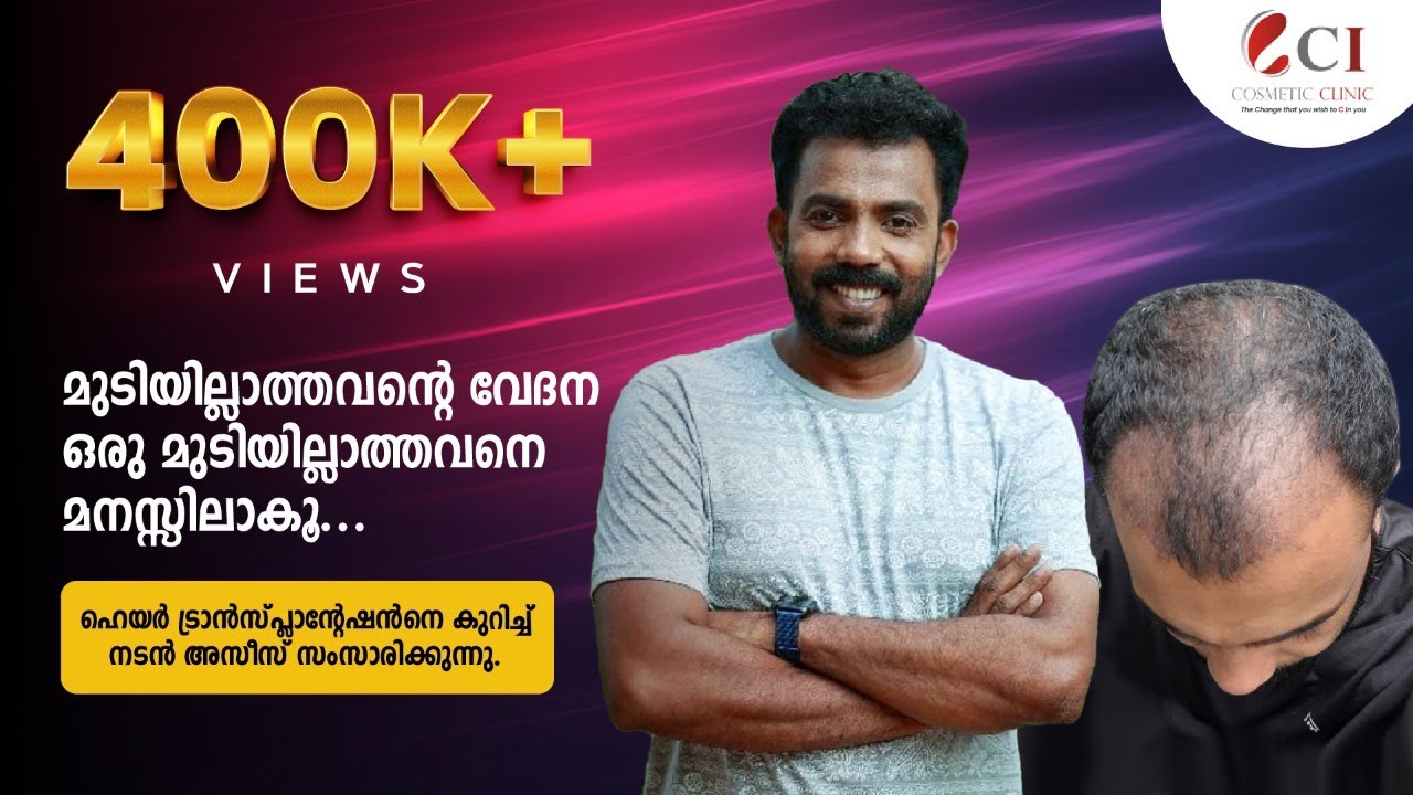 Hair Transplantation Kerala | Hair Transplantation done by Malayalam Cine artist Azees Nedumangad