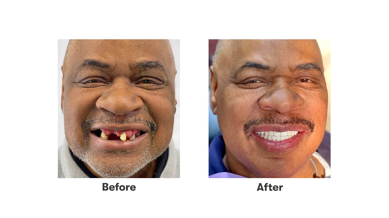 Flexcera&trade; Smile Ultra+ | 3D Printed Smiles