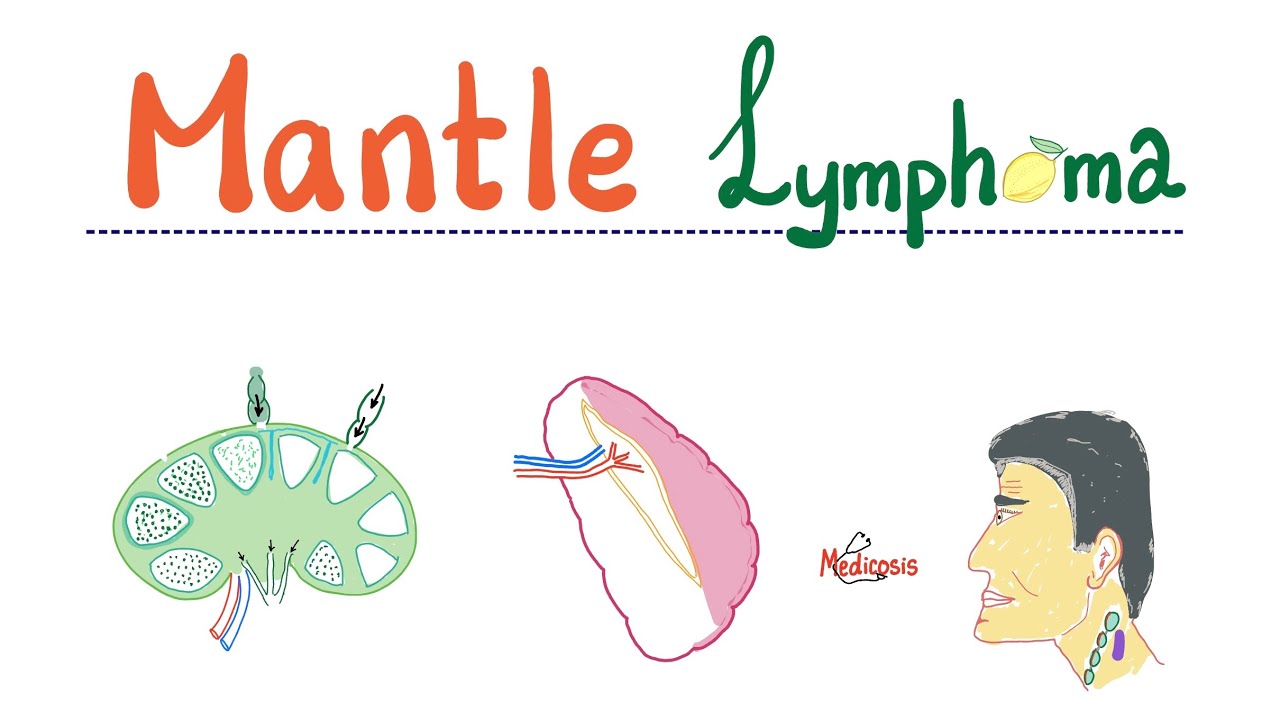 Mantle Cell Lymphoma - Aggressive B-Cell Neoplasm - Non-Hodgkin’s Lymphoma (NHL) - Hematology