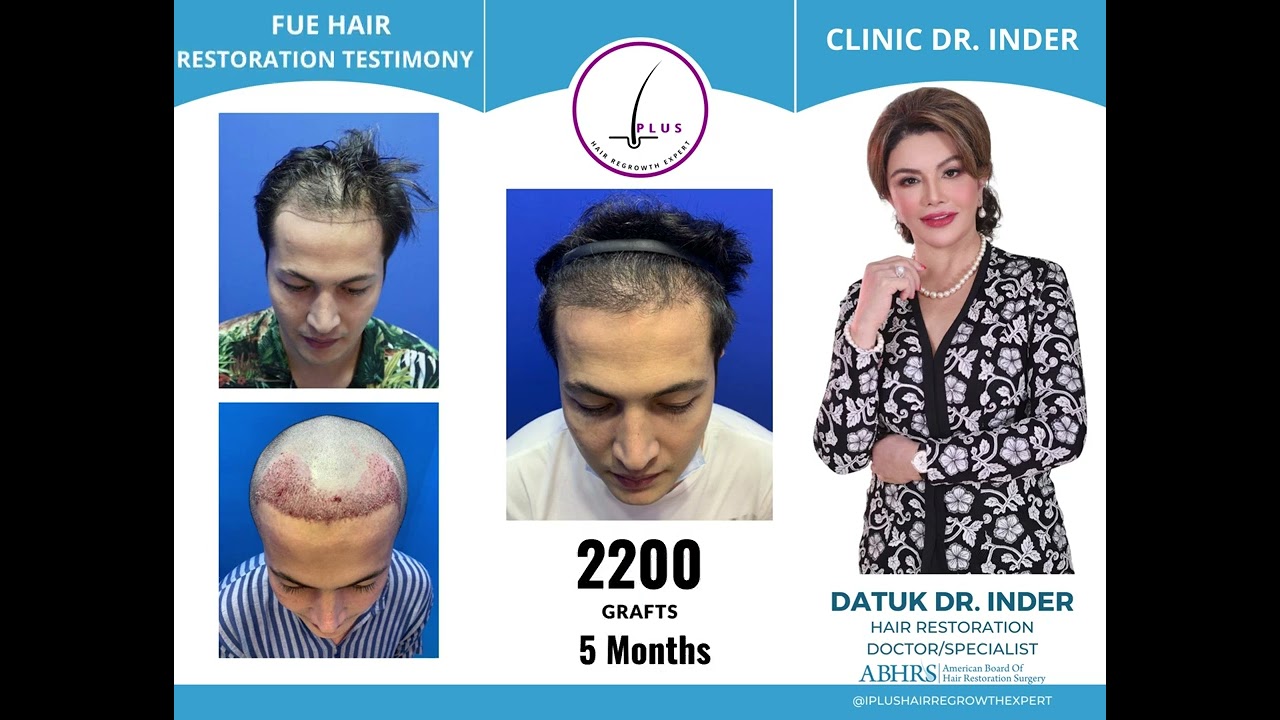 5 Months Testimony after FUE Hair Transplant - Daler Yusuf (Malaysian Actor)