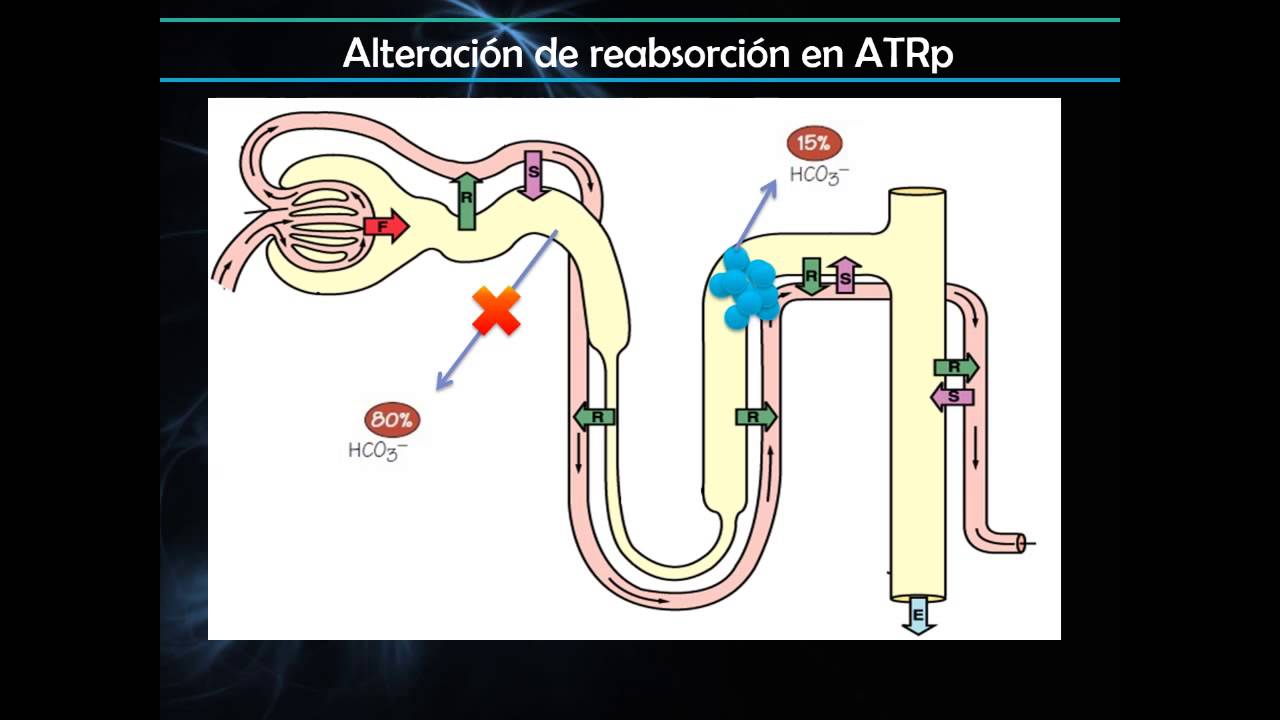 2016/04 - Acidosis Tubular Renal en Pediatría