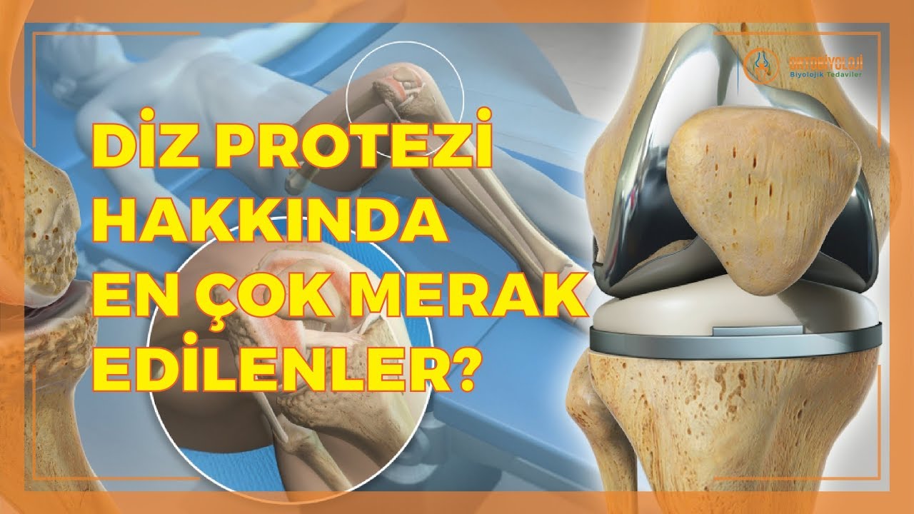 DİZ PROTEZİ HAKKINDA EN ÇOK MERAK EDİLENLER?