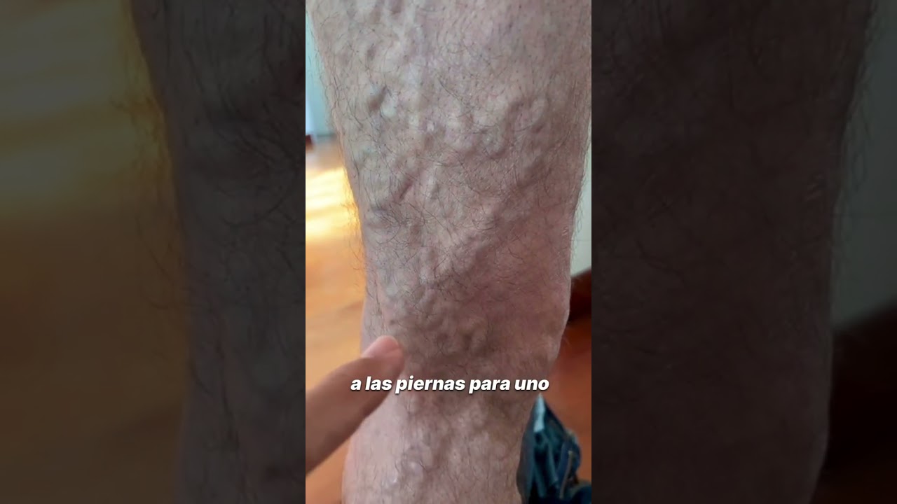 Venas varicosas - Doctor Rojas.