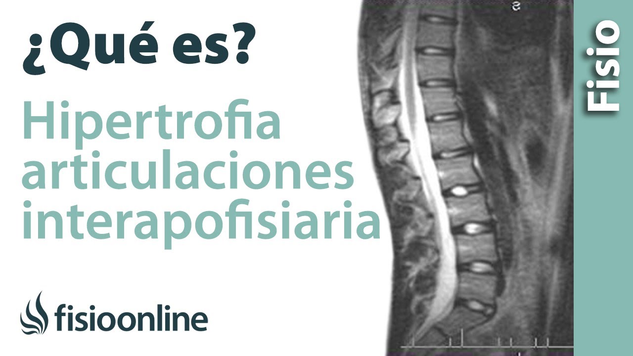 Hipertrofia de las articulaciones interapofisarias o facetarias - &iquest;Qu&eacute; es?