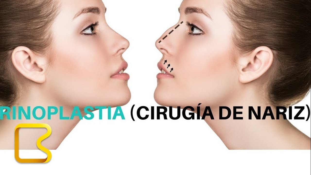 Rinoplastia - cirugía plástica de la nariz