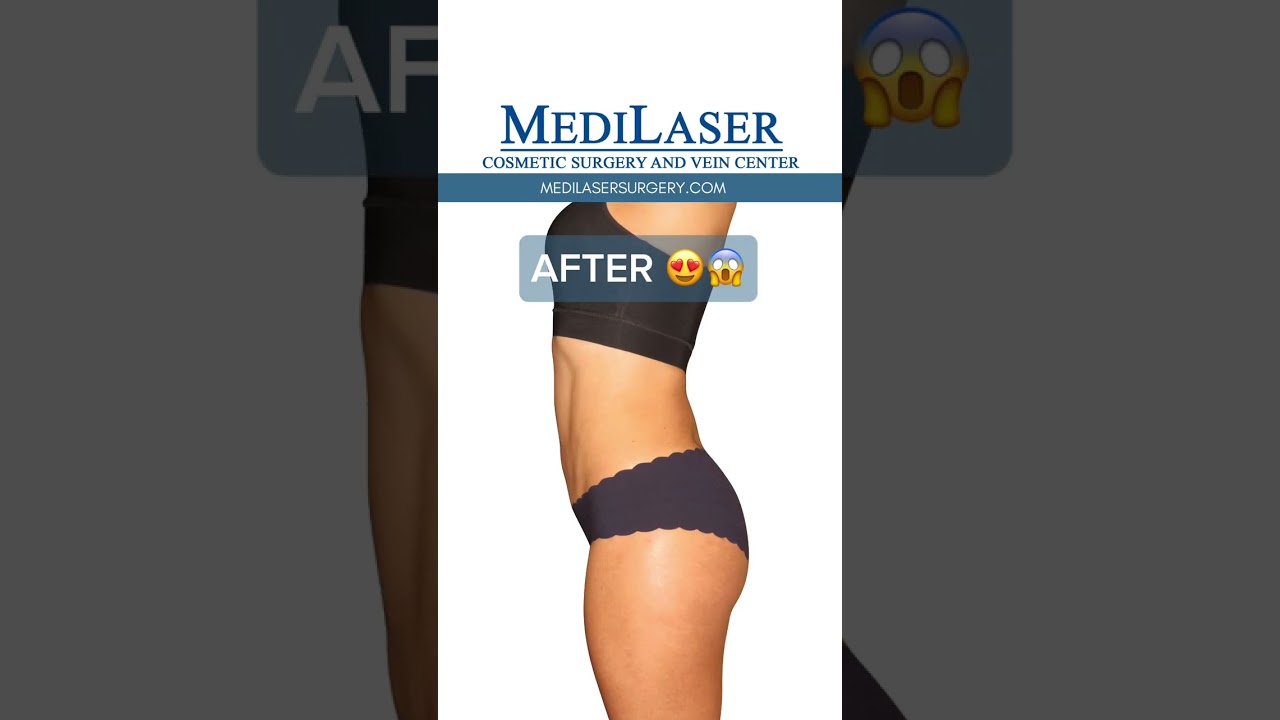 LIPO + RENUVION B&A
