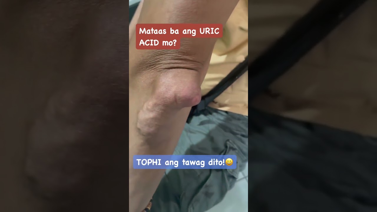 Bukol bukol sa mga kamay , paa , siko , tuhod at iba pa&mdash; dahil sa mataas na uric acid! #uricacid