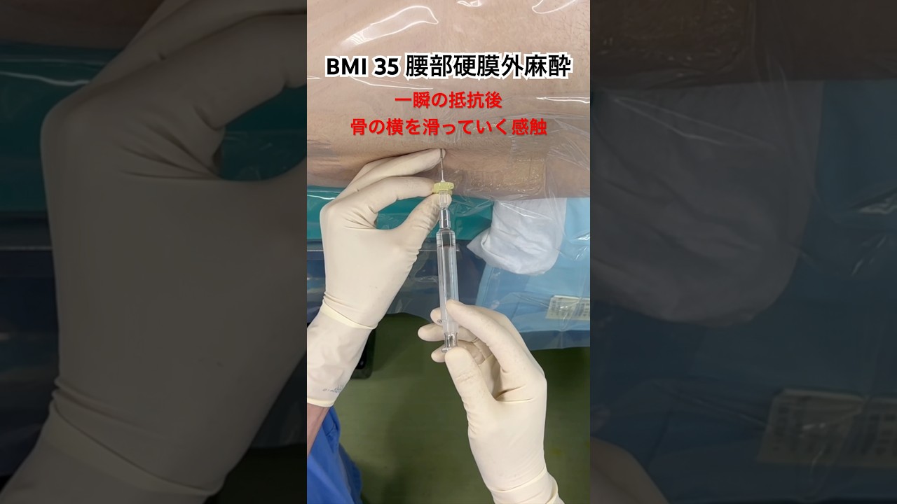 BMI 35 腰部硬膜外麻酔💉epidural anesthesia by Dr.EpiCal #shorts
