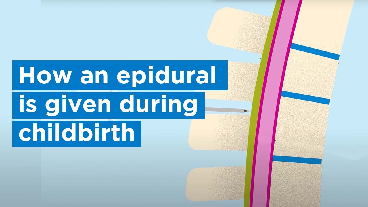 How an epidural is given during childbirth | Bupa Health