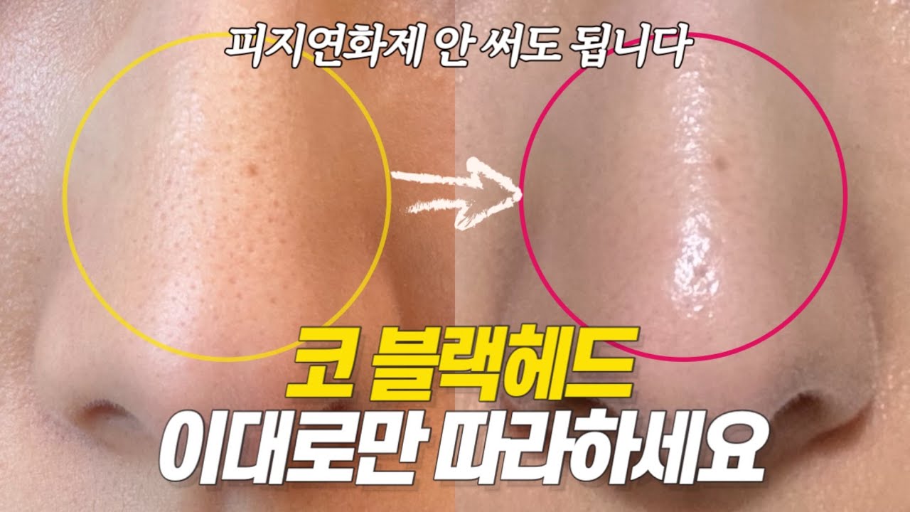 피지연화제 필요 없음❌ 가장 '자극없이' 블랙헤드 제거하는 법