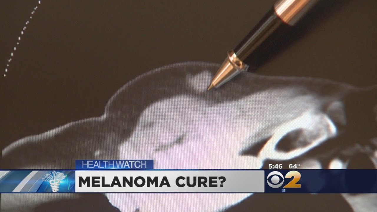 Dr. Max Gomez: Melting Melanoma