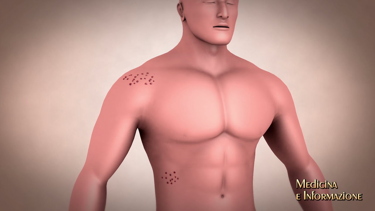 Herpes Zoster e Nevralgia post-erpetica: chi sono le persone a rischio e chi può fare la profilassi
