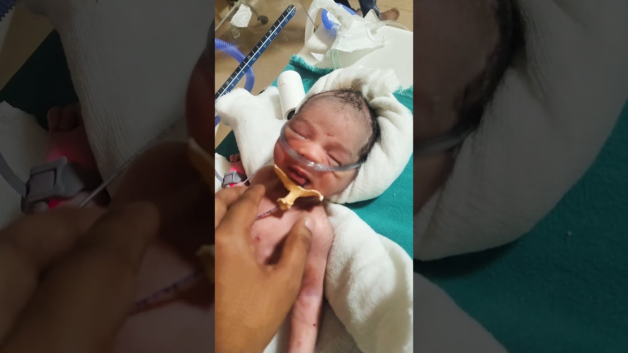 Pre term baby #junior #birth #pretermbaby #respectmother #respectmother #medicalstudent