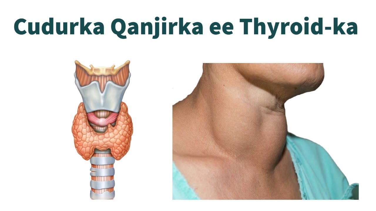 Cudurka ku dhaca qanjirka ee Tyroid-ka | Thyroid Disease |  Somali Bridge - WA