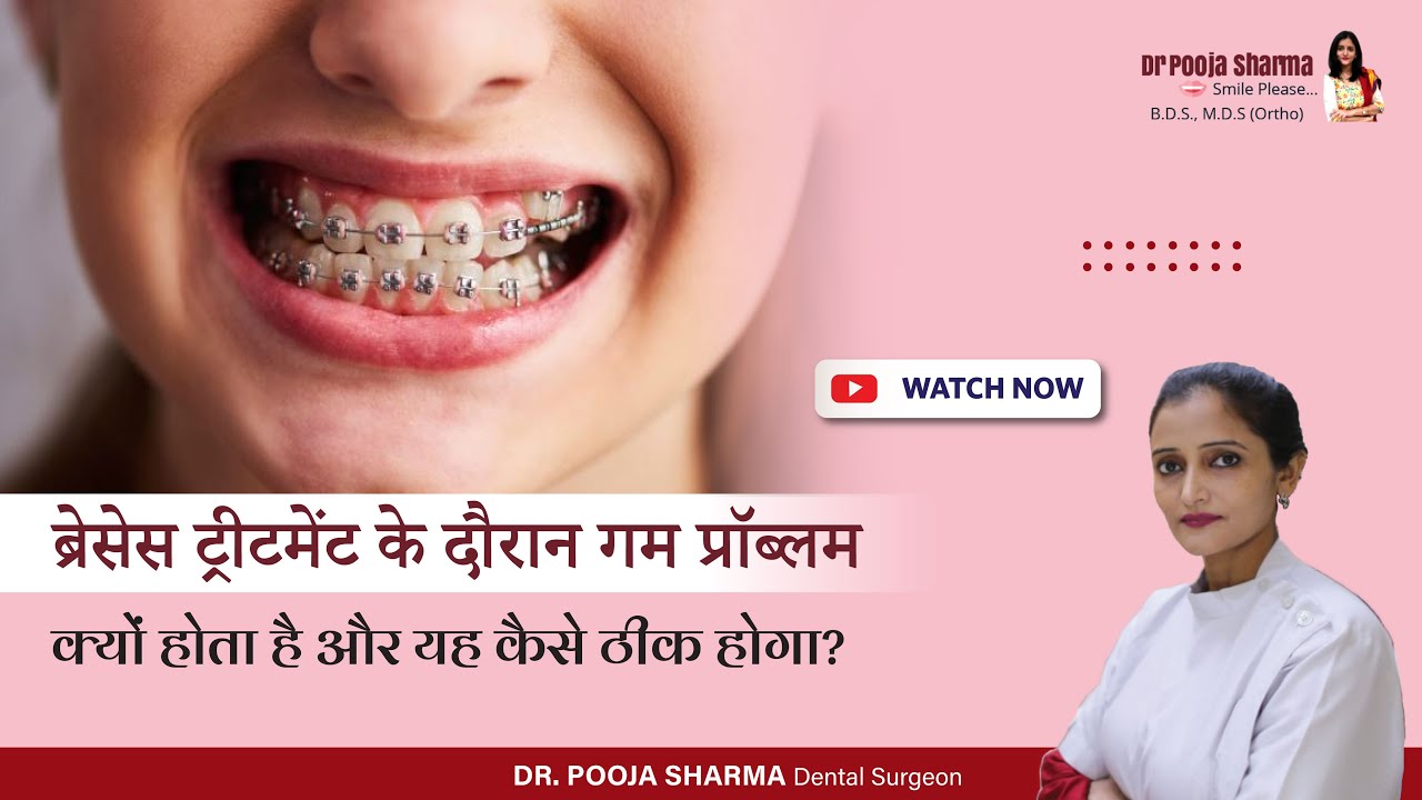 ब्रेसेस ट्रीटमेंट के दौरान मसूड़ों में समस्या और उसका इलाज | Braces & Gums Treatment In Agra , UP