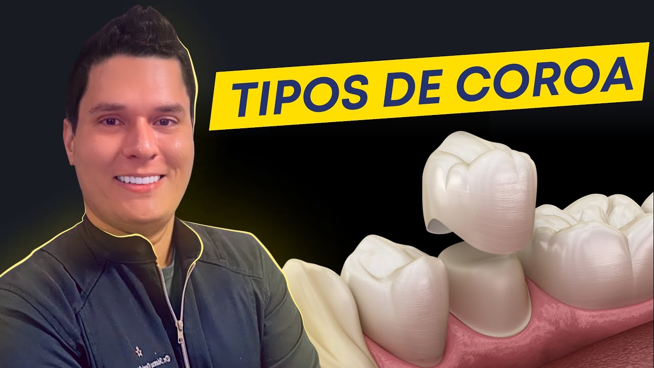 TIPOS DE COROAS DENT&Aacute;RIAS E SUAS INDICA&Ccedil;&Otilde;ES!