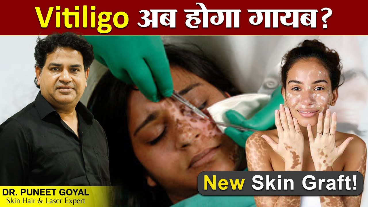 Safed Daag (Vitiligo) – Latest Skin Grafting Treatment Explained | Dermatologist’s Guide