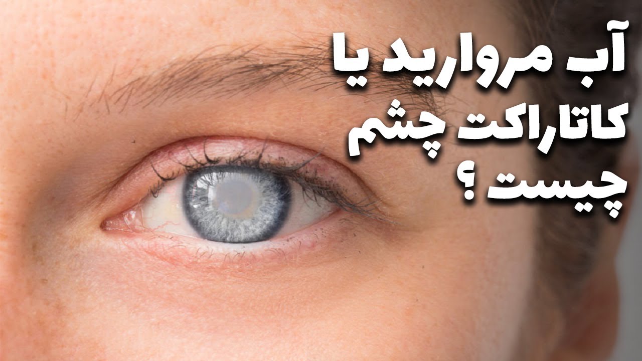 Nosh Daro - Aab Murwarid Ya Katarakat Cheshm Chest ? | نوش دارو - آب مروارید یا کاتاراکت چشم چیست ؟