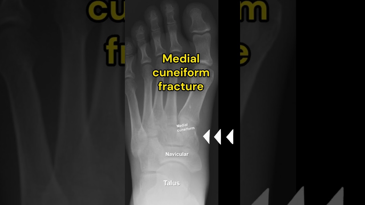 Medial cuneiform fracture