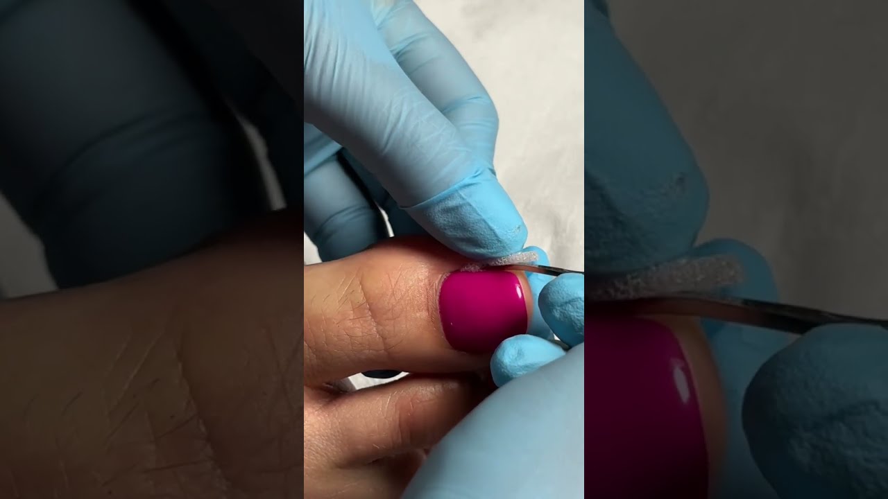 Zobacz, jak samodzielnie zaaplikować tamponadę podczas wrastania paznokcia! #podologia #feetclinic