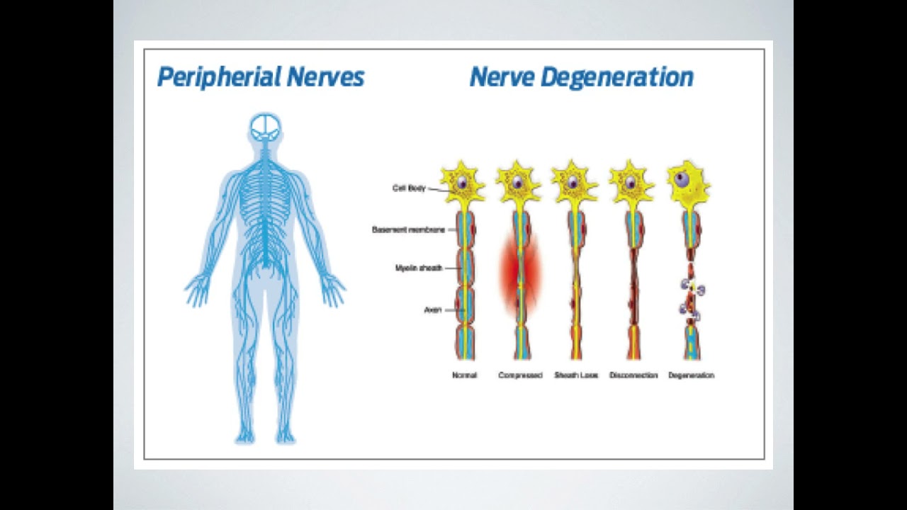 Explanation of Care: Chiropractic, Neuropathy and Decompression