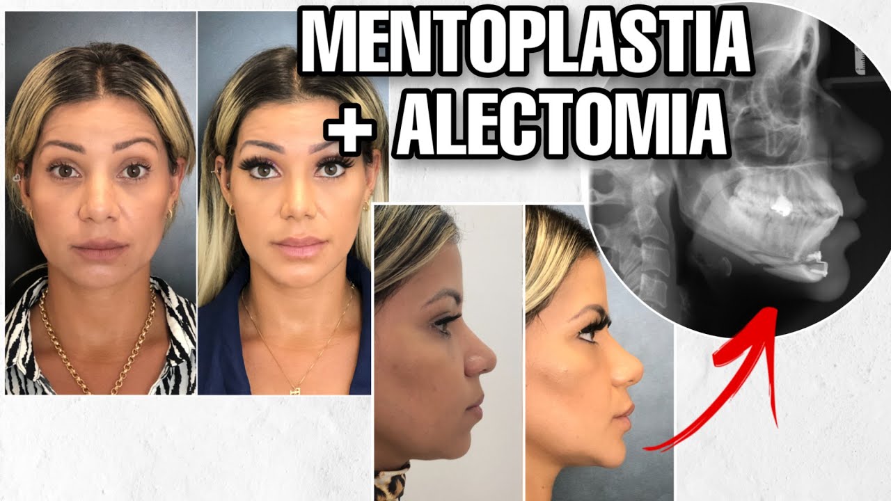 MENTOPLASTIA + ALECTOMIA - Diário pós cirúrgico, preço, resultado parcial...