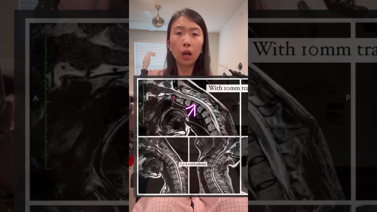 Surgical Plan for CCI AAI Cervical Fusion| Amy Wang-Hiller