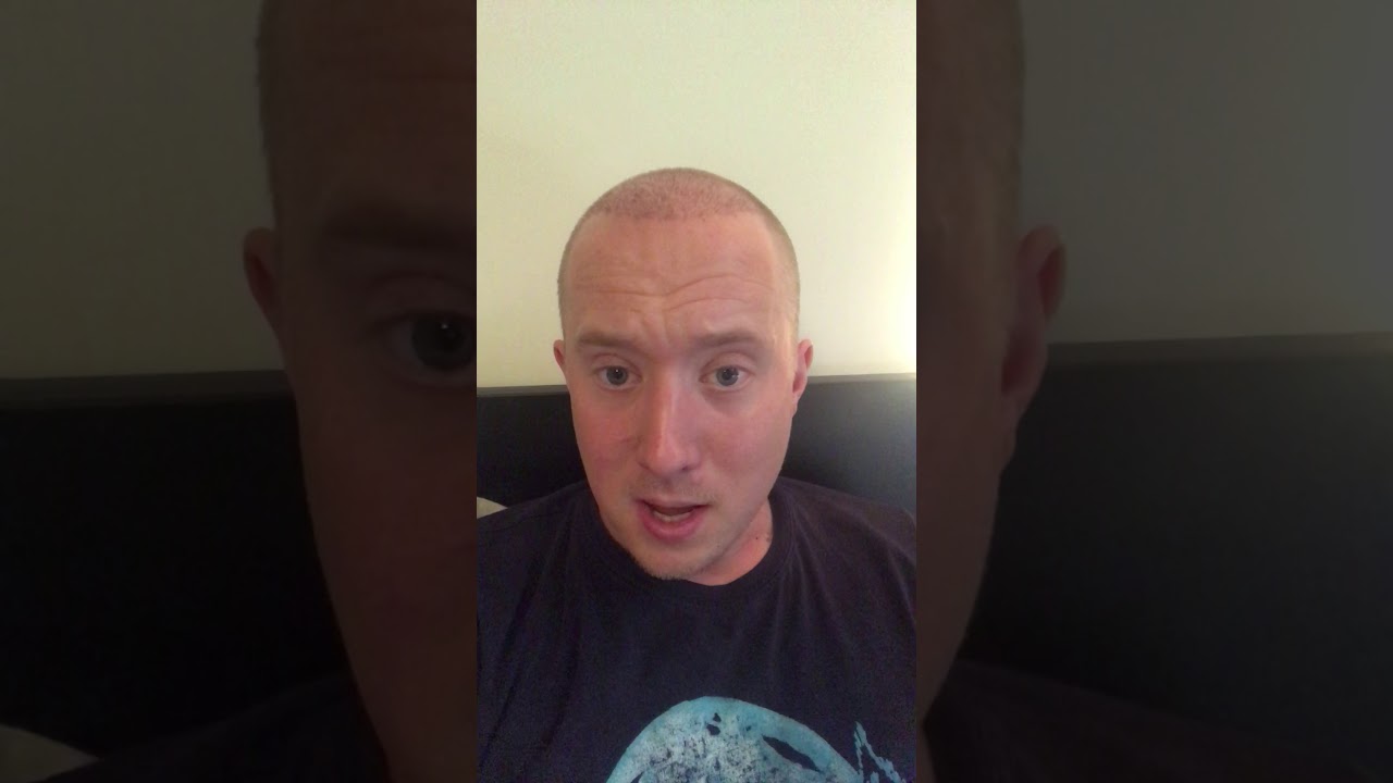 Hair Transplant Day 12