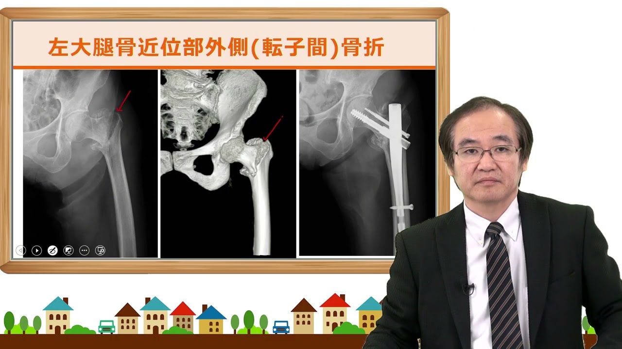 2 2 3 2 大腿骨近位部（頚部）骨折