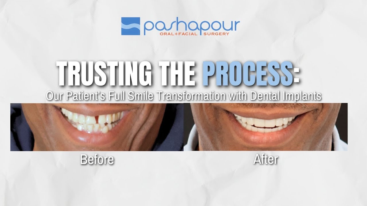 Trusting the Process: Our Patient’s Full Smile Transformation with Dental Implants