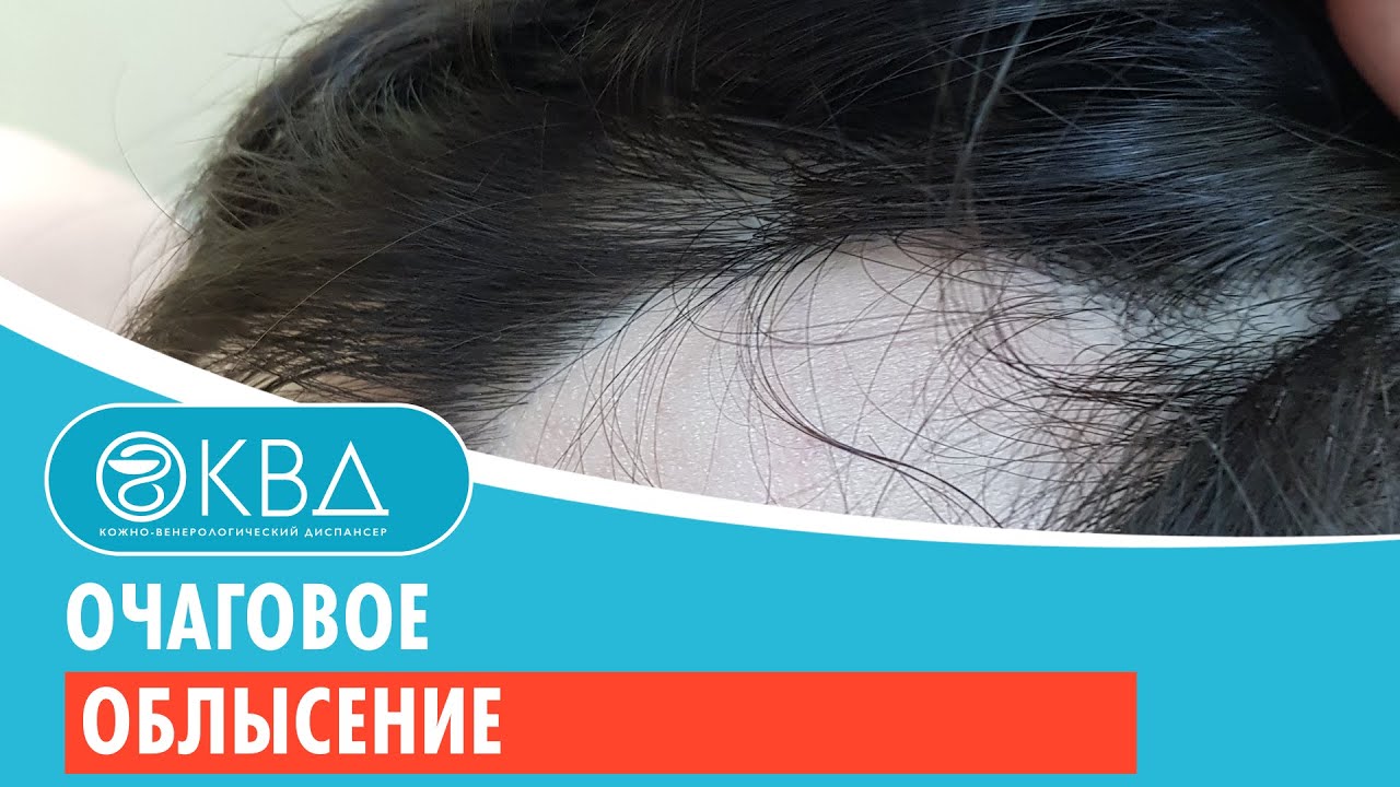 ✋ Очаговое облысение. Клинический случай №915