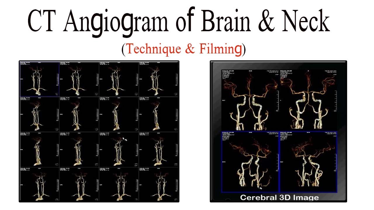 CT Angiogram of Brain and neck technique and filming