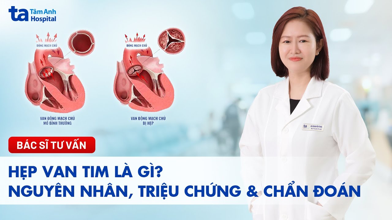 Hẹp van tim là gì? Nguyên nhân, triệu chứng, chẩn đoán, điều trị | BS.CKI Nguyễn Tô Hòa