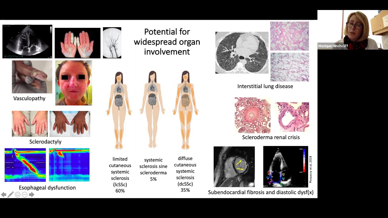 UW Rheumatology Grand Rounds - Dr. Monique Hinchcliff