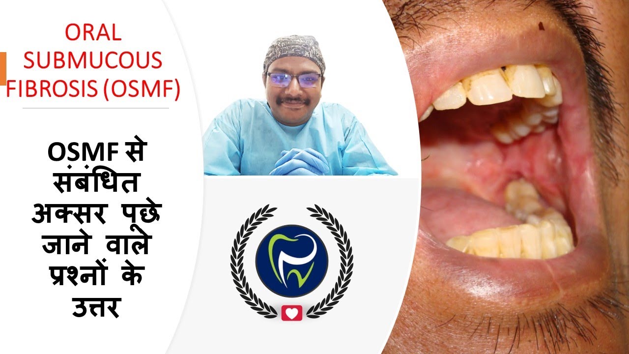Dr Rudra Mohan |OSMF से संबंधित अक्सर पूछे जाने वाले प्रश्नों के उत्तर|Oral Submucous Fibrosis(OSMF)