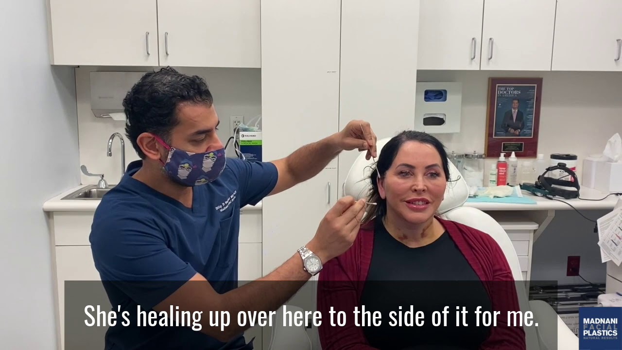 1 Day After a Facelift and Neck Lift