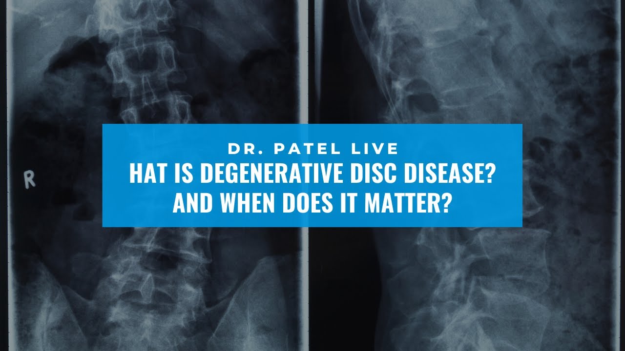 Dr. Patel LIVE: What is degenerative disc disease? And when does it matter?