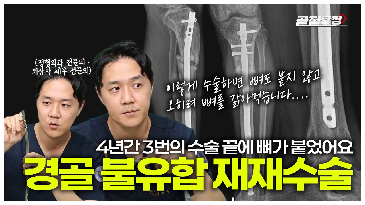 4년간 3번의 수술 끝에 얻은 골유합｜경골 불유합 재수술｜잘못된 역동화의 결과?
