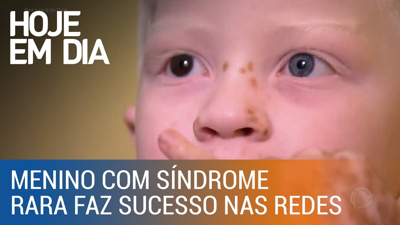 Menino com síndrome rara faz sucesso nas redes sociais