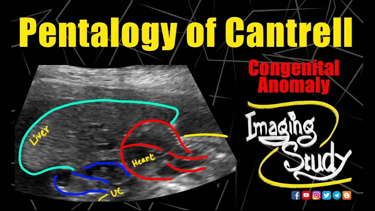 Pentalogy of Cantrell | Gastroschisis | Ectopia Cordis || Ultrasound || Anomaly || Case 289