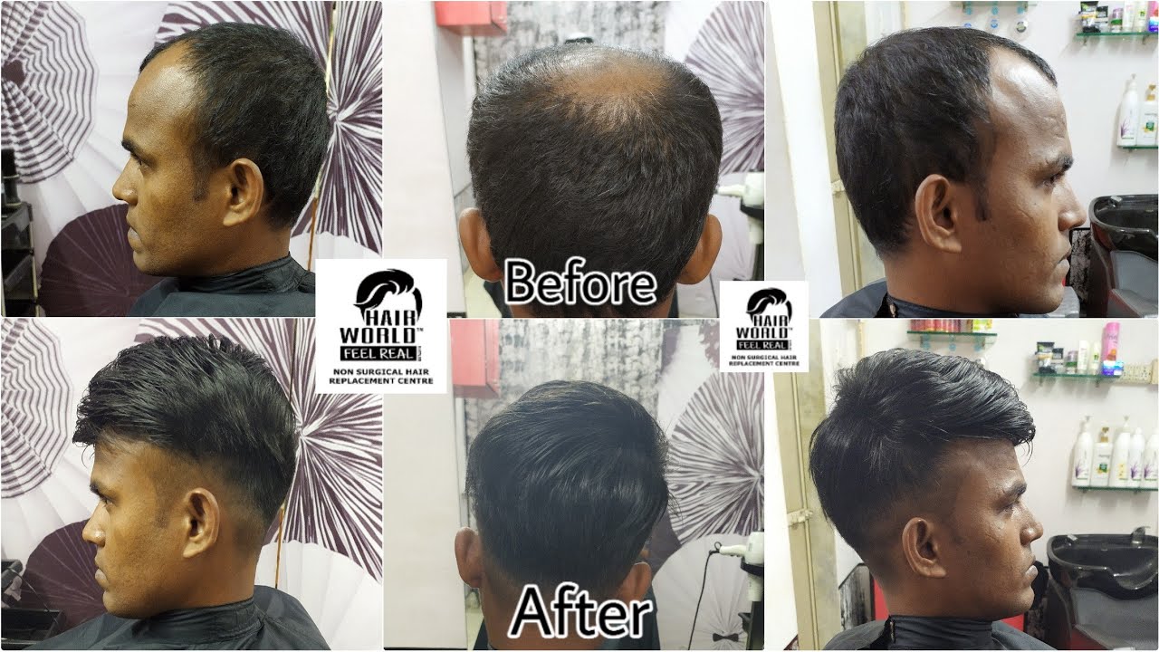 Non Surgical Hair Replacement for Men | Hair Fixing For Men | Hair Patch | Hair Replacement - HW