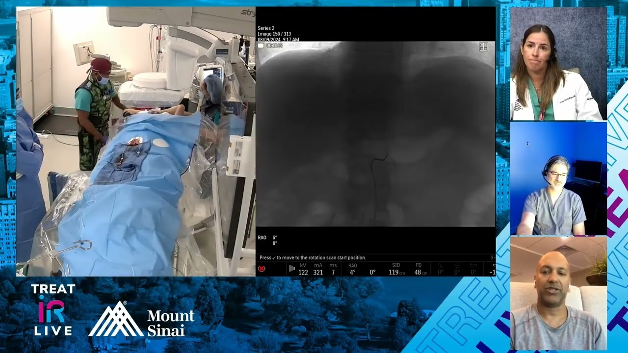 Y90 Radioembolization with Glass Microspheres for Infiltrative Hepatocellular Carcinoma (HCC)