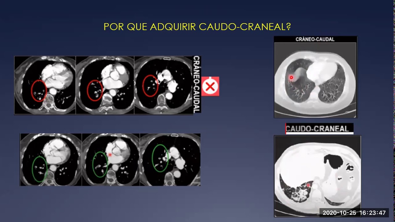 12 Angio TC de las Arterias Pulmonares evidencia actual, bajo kilovoltaje y baja dosis de contraste